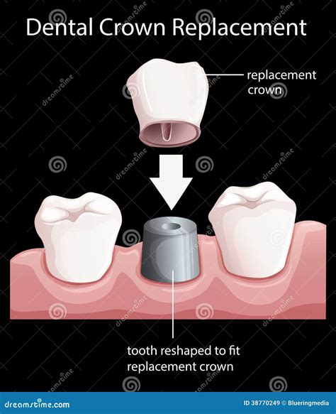 A Dental Crown Replacement Royalty Free Stock Images - Image: 38770249