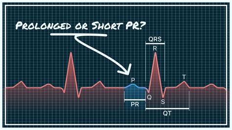 QALY | PR Interval on Your Watch ECG – Short, Normal, and Prolonged