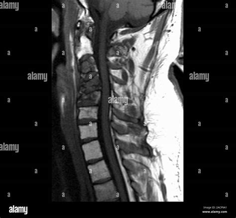 Spinal cancer. Magnetic resonance imaging (MRI) scan of a sagittal section through the cervical ...