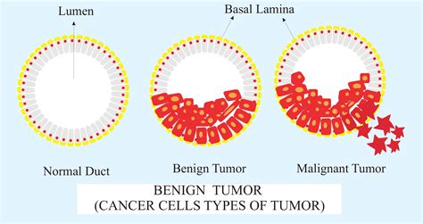 Benign Tumor