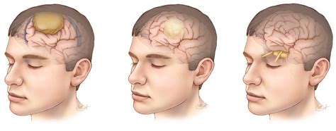 Types Of Benign Brain Tumors