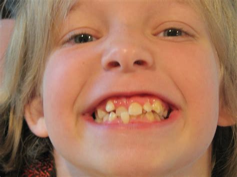 Rocks In The Washer: Before and After - Braces!