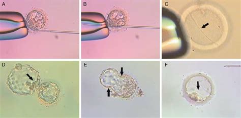 Various outcomes of the controlled zona dissection. ( A ) Hatching... | Download Scientific Diagram