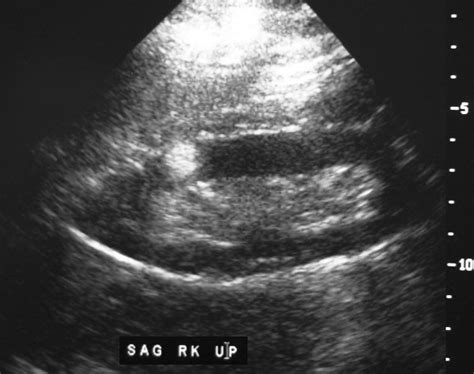 Renal Cell Carcinoma Ultrasound | Kidney