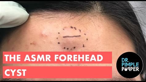 The ASMR Forehead Cyst - YouTube