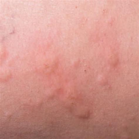 How to Identify 4 Common Skin Rashes | Alergia piel, Picazon en la piel, Alergias