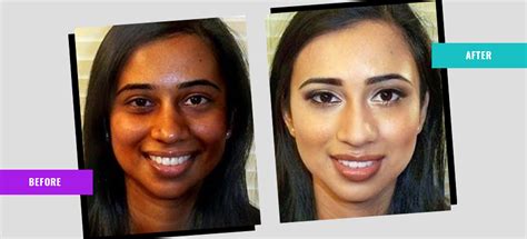 Skin Whitening in Gurugram - Dr. Suman's Cosmetic Surgery & Skin Clinic