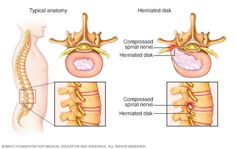 Birmania amplitud vaquero hernia discal cola de caballo Vatio Cuadrante ...