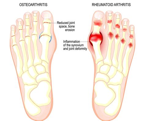 Injured Big Toe Joint