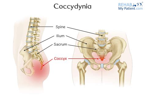 Coccydynia | Rehab My Patient