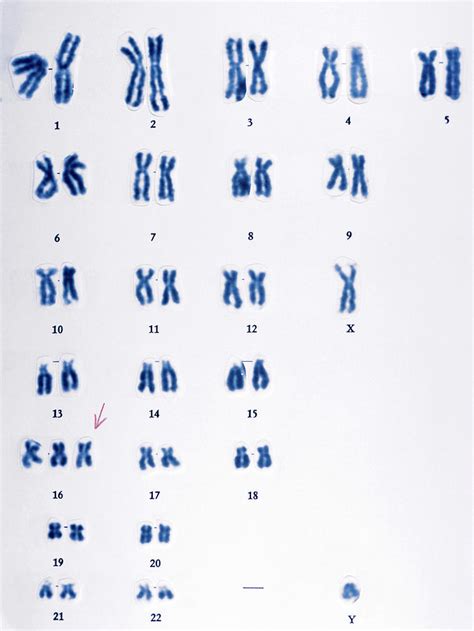 Trisomy 16 Chromosomes Photograph by Cnri/science Photo Library - Pixels