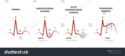 8 Nstemi Stock Vectors and Vector Art | Shutterstock