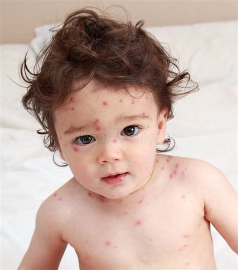 Chicken pox rash stock image. Image of protection, portrait - 25619011