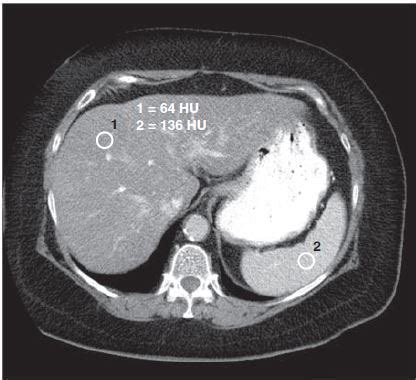 CT Scan of the Liver and Enhancing Phases - RadTechOnDuty