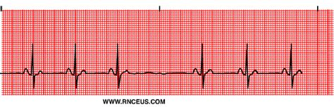 Sinoatrial Block