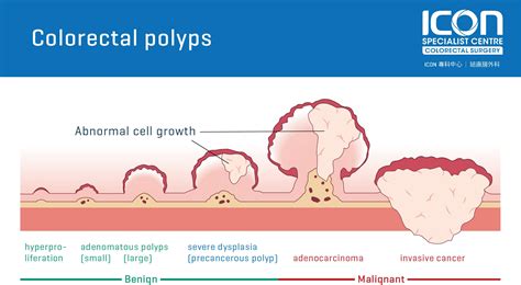 Colorectal Cancer Polyps