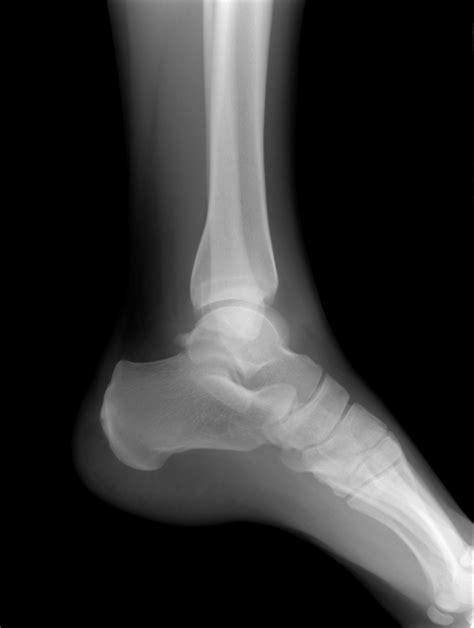 ankle-x-ray-1430507-639x847 - Ability Rehabilitation