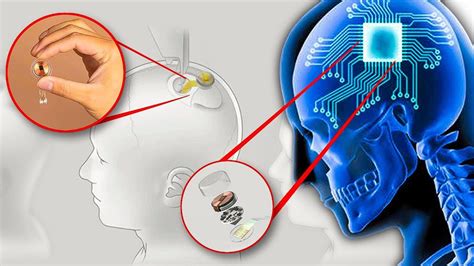 Elon Musk Neuralink Brain Chip - The Digital Tech