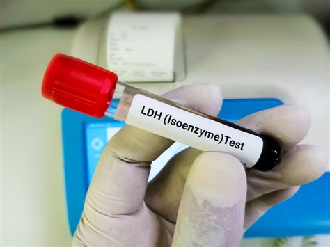 High LDH in blood: causes and treatment - Ambar Lab