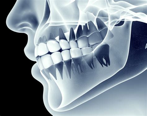 Jawbone Loss And Deterioration - Ehsan Rezvan DDS, MS