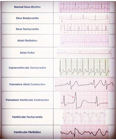 √ How To Read Ecg