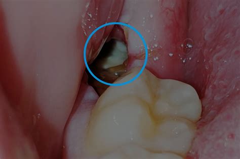 Is It Normal to See Bone After Wisdom Tooth Extraction?