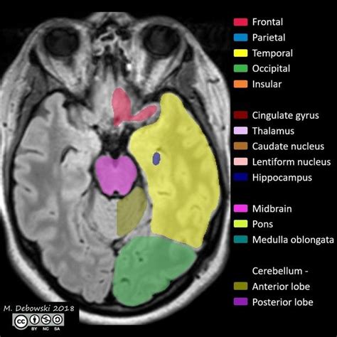 Brain lobes - annotated MRI | Radiology Case | Radiopaedia.org | Mri brain, Brain lobes, Mri