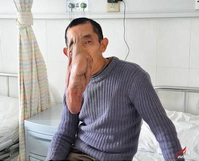 Meet The Man With A Massive Tumor On His Face Like That Of An Elephant (Photos) | OmoMedia - Anuli