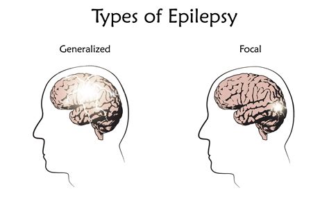 Epilepsy Types