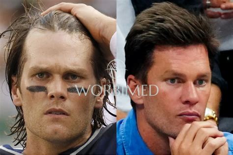 Tom Brady Hair Transplant l Before and After