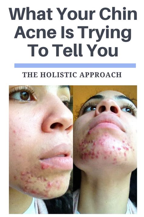 What Your Chin Acne Is Trying To Tell You | Chin acne, How to get rid of acne, Bad acne