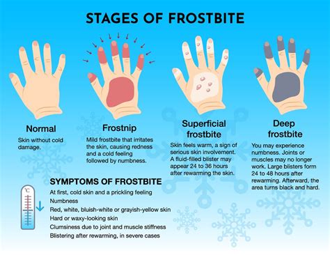 Frostbite symptoms: How cold does it need to be to get it and how fast ...