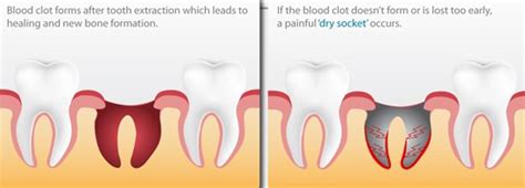 wisdom teeth extraction and dry sockets