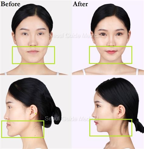 Before And After Double Jaw Surgery - Seoul Guide Medical