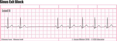 ECG Educator Blog : Sinus Exit Block