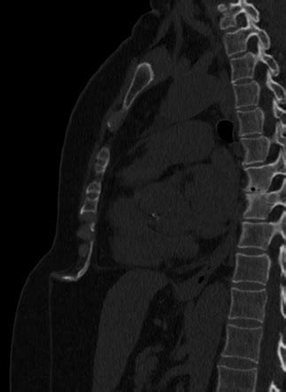 Xiphoid shape variations | Radiology Reference Article | Radiopaedia.org