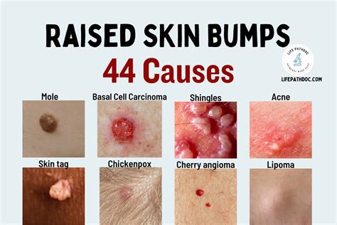 Raised Skin Bumps: 44 Causes, Pictures and Treatment