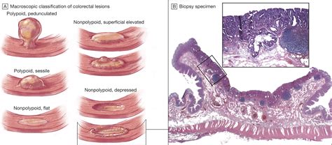 Prevalence of Nonpolypoid (Flat and Depressed) Colorectal Neoplasms in Asymptomatic and ...