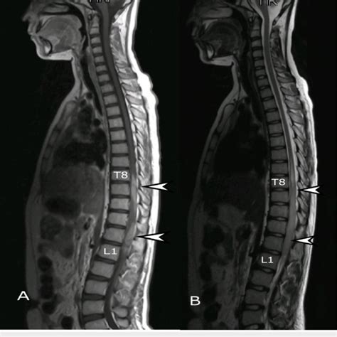 MRI whole spine, sagittal view. (A) T2 weighted and (B) T1 weighted... | Download Scientific Diagram