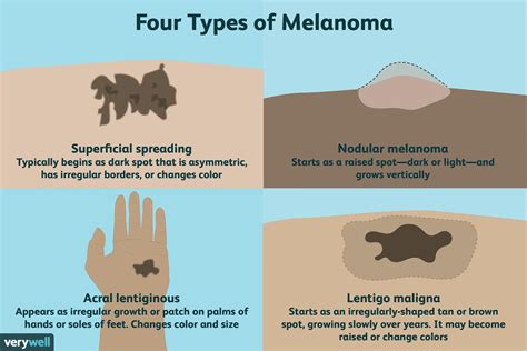 Melanoma: Symptoms, Staging, Treatment, and More