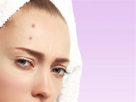 Get Rid Of Bumps On Your Forehead - get rid of bumps