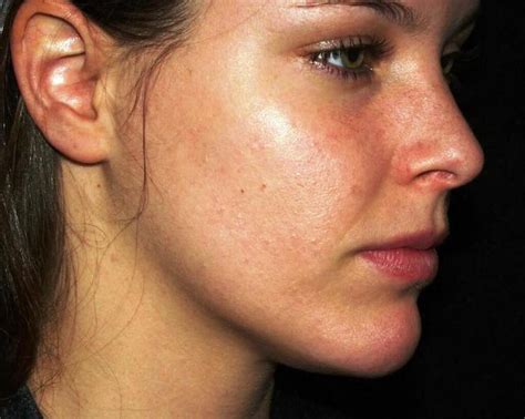 Skin acne: Signs, Symptoms, Complications and Cause