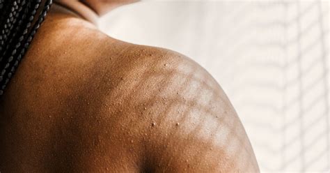 Raised Skin Bumps: Pictures, Types, Causes, and Treatment