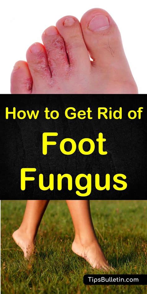 How to Get Rid of Foot Fungus - Home Remedies - Treatments