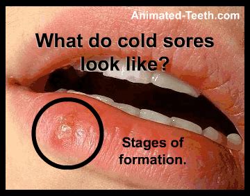 Cold sore (fever blister) stages – Pictures, Signs & Symptoms. Are they ...