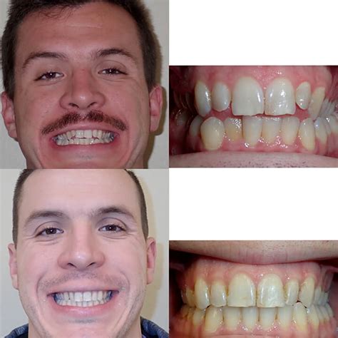 Before & After Braces | Wazio Orthodontics