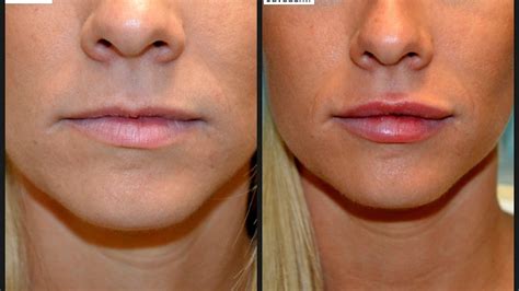 Juvederm Side Effects Lips - Effect Choices