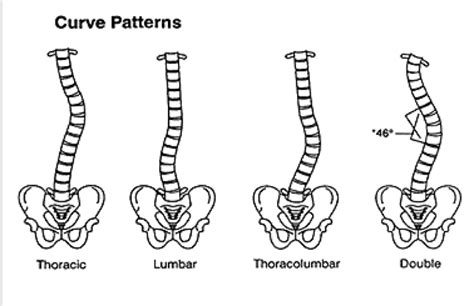 Yoga for Scoliosis: It depends | The Yoga Institute