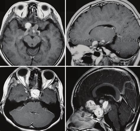 Optic glioma is classified roughly in a) optic nerve (anterior type ...