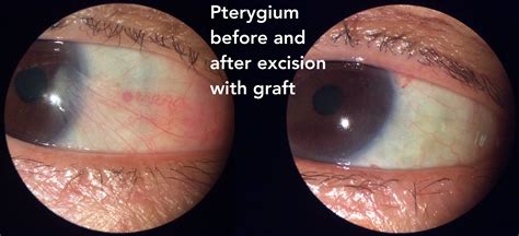 Pterygium surgery